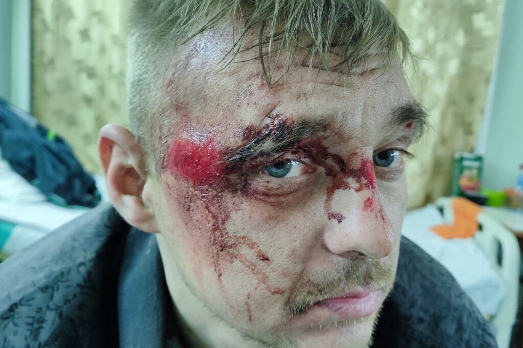 Инвалид-колясочник рассказал, как попал под грузовик, и почему остался без ног